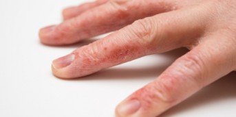 dermatitis eczema ragadi neurodermitis eksem handekzem psoriasis dita successfully fingern hautkrankheit
