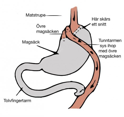 Illustration av gastric bypass