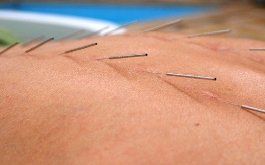 akupunktur mot foglossning