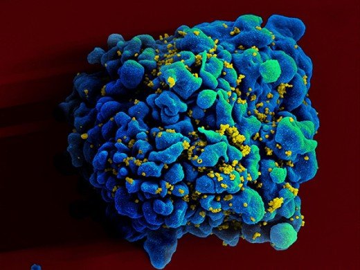 En HIV-infekterad cell.