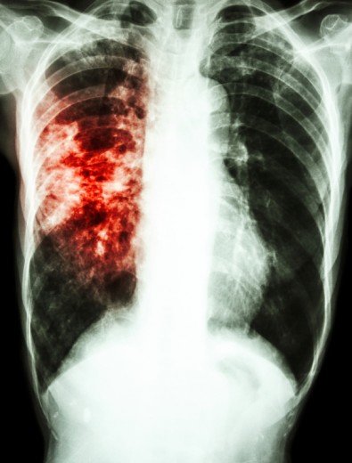 tuberkulos