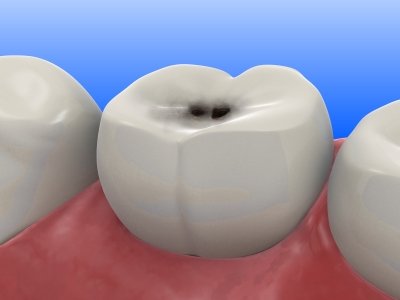Digital bild av en tand med karies.
