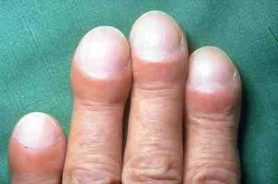 Svullnad på fingrar på grund av lungfibros