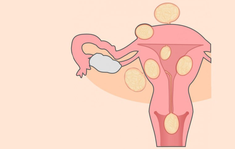 myom i livmodern operation