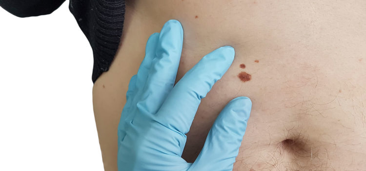 Läkare undersöker födelsemärke som kan vara malignt melanom