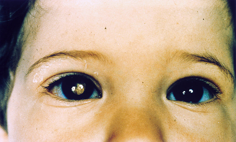Bild på ett barn med ögoncancern retinoblastom.
