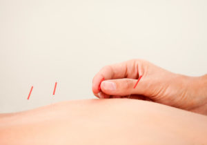 Person får akupunktur
