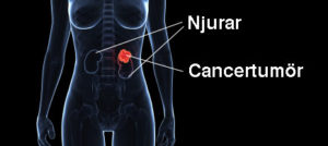 Digitalbild av njurar och cancertumör