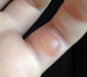 Ett finger som bildat en blåsa vid brännskadeolycka.