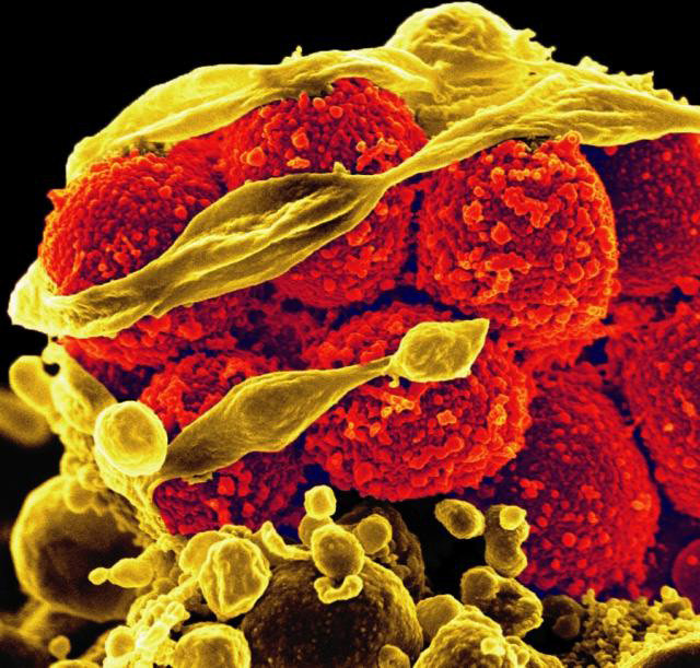 Bakterien MRSA (i röd-orange) dödar och flyr en vit blodcell (i gult).
